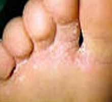 Las raíces de la enfermedad la psoriasis